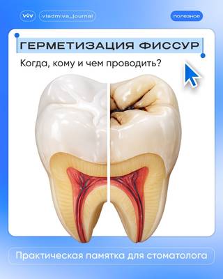 Герметизация фиссур — надёжный барьер для здоровой эмали.